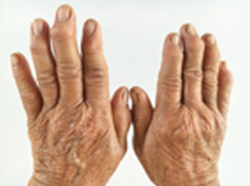 Facts You Should Know About Arthritis Diagnosis and Treatment