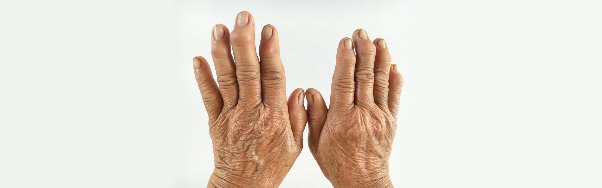 Facts You Should Know About Arthritis Diagnosis and Treatment